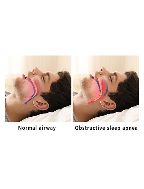 side-by-side photos depicting the difference between a normal and obstructed airway